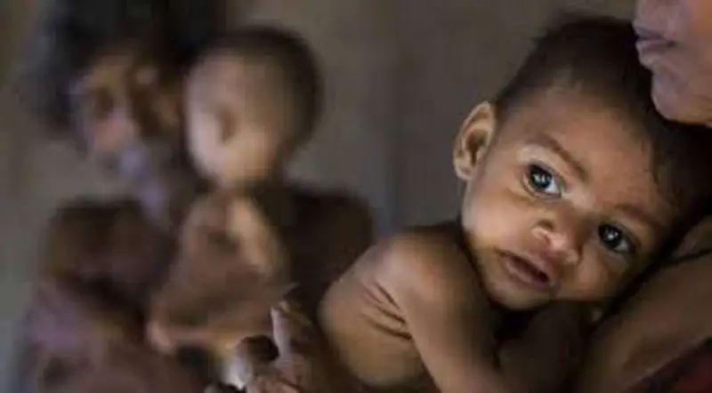 Malnutrition: कुपोषण से निपटने के लिए राष्ट्रीय स्तर पर भागीदारी जरूरी