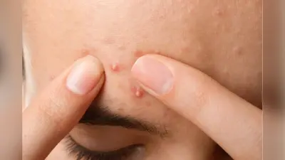 Mistakes that Cause Pimple Marks: पिंपल होते ही करने लगते हैं ये गलतियां, तभी रह जाते हैं दाग-धब्बे