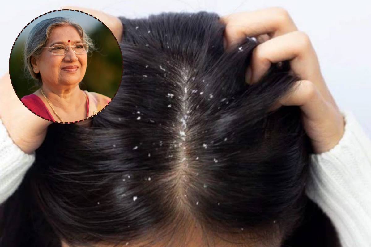 ड्राई स्कैल्प की समस्या से परेशान? डॉ. हंसा जी से जानें आसान घरेलू उपाय और जरूरी टिप्स