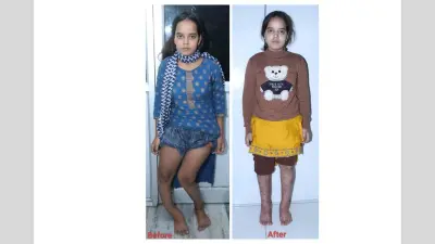 नारायण सेवा संस्थान ने बदली मधुबनी की चांदनी की जिंदगी, गंभीर दिव्यांगता से मिली नई उड़ान