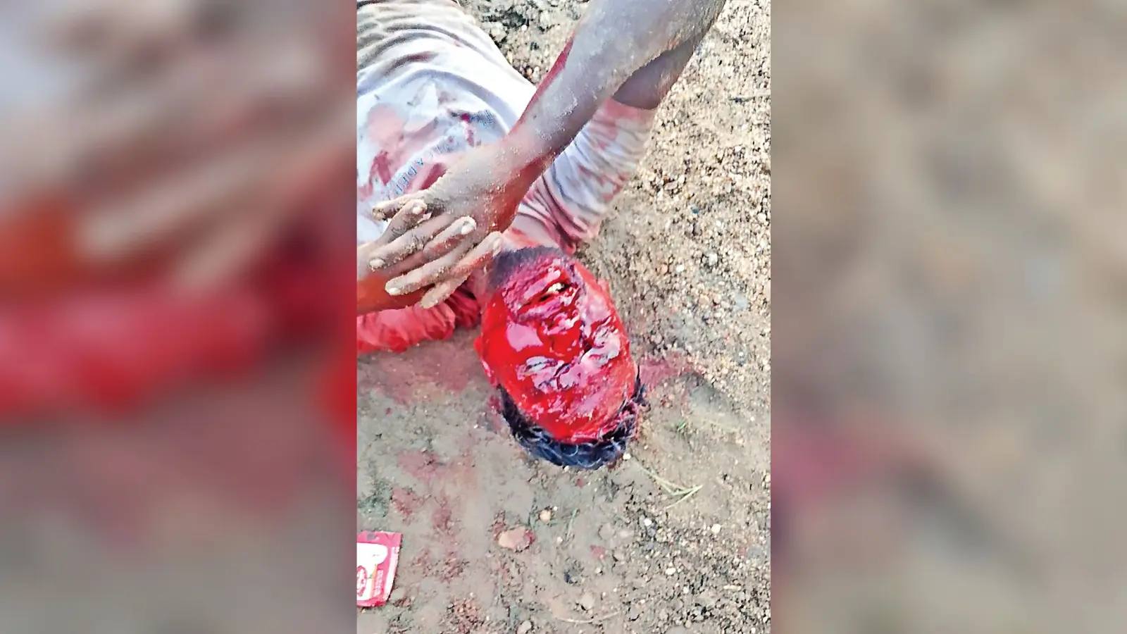 Chaibasa News : मौत के मुंह से लौटा युवक, दो जंगली भालुओं से 15 मिनट तक लड़ा