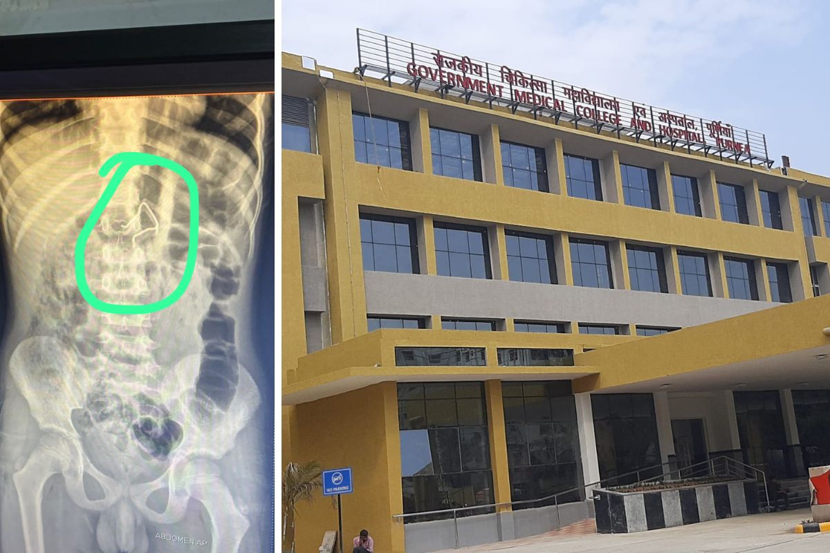 जीएमसीएच में चमत्कार, 6 साल के बच्चे की आंत में फंसा स्प्रिंग बिना चीरा लगाए निकाला