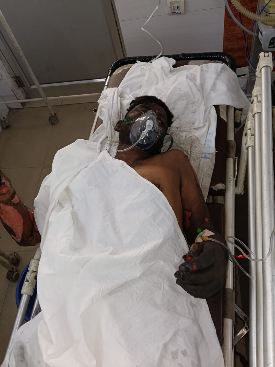 गैलेक्सी इंगोट प्लांट के फर्नेस में ब्लास्ट, बिहार के दो मजदूर झुलसे, हालत गंभीर
