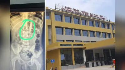 जीएमसीएच में चमत्कार, 6 साल के बच्चे की आंत में फंसा स्प्रिंग बिना चीरा लगाए निकाला