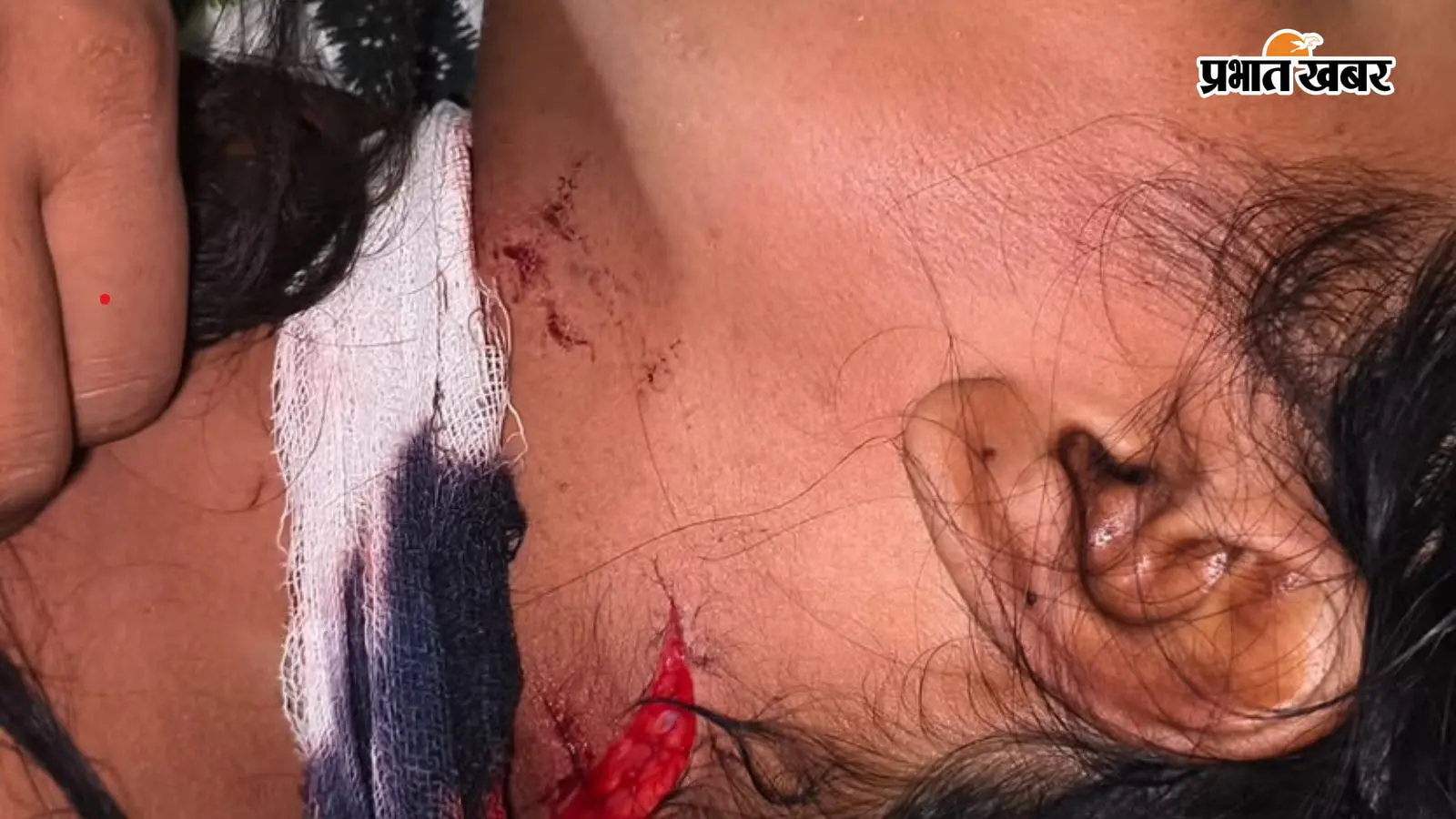 दरौली के बेलांव में धारदार हथियार से हमला, तीन लोग गंभीर घायल, सदर अस्पताल रेफर