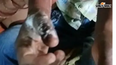 महुआ में 11 हजार वोल्ट हाई वोल्टेज तार की चपेट में आने से छह वर्षीय बालक झुलसा, निजी अस्पताल में भर्ती