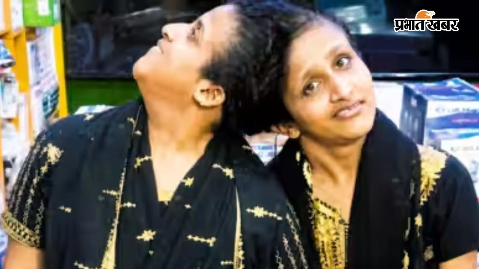तीन महीने बाद सबा-फराह को मिली जरूरी दवाएं, अब हर महीने बिहार के विशेषज्ञ डॉक्टरों की टीम करेगी स्वास्थ्य जांच