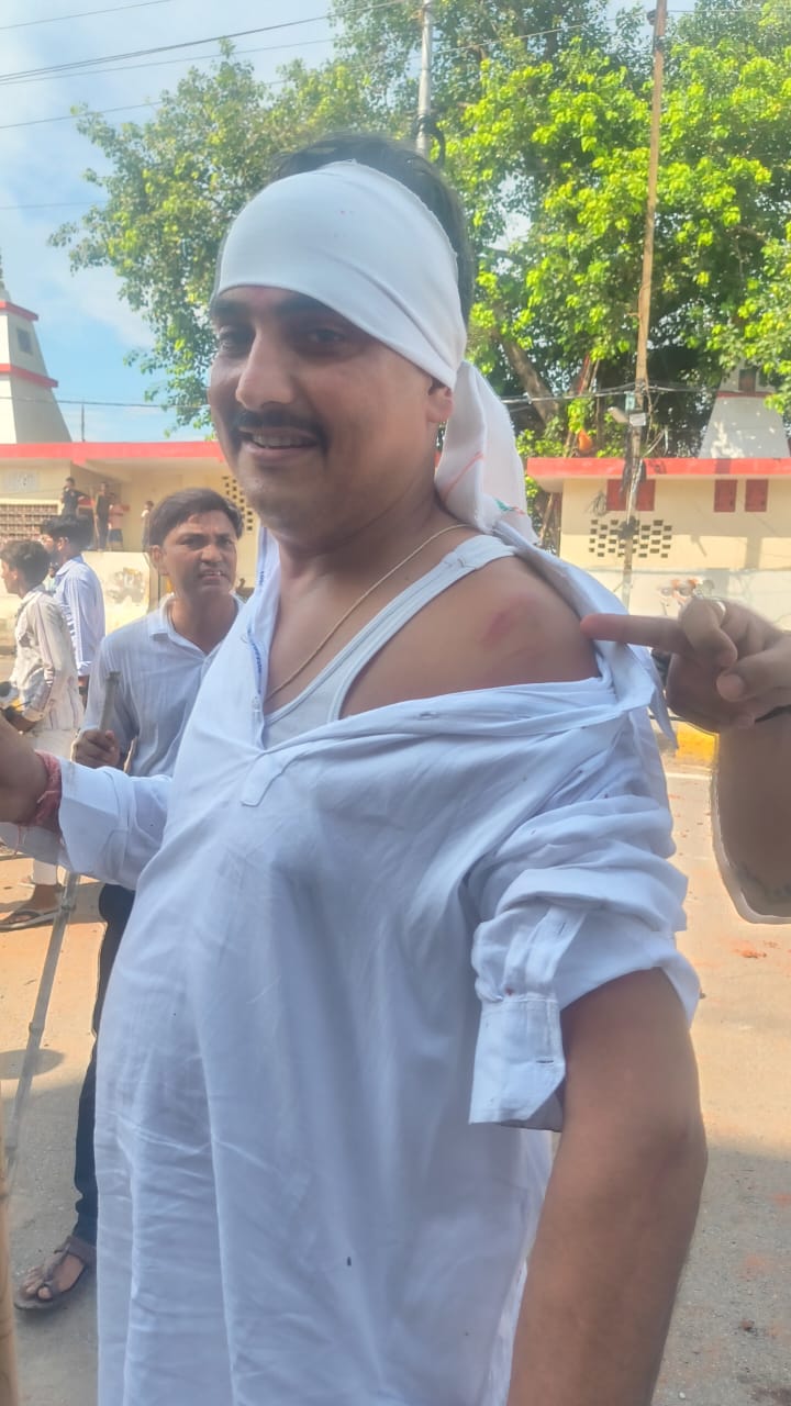 झड़प में घायल कार्यकर्ता ने दिखाए चोट के निशान।