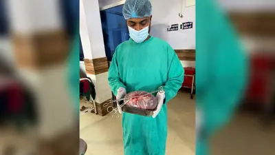 न्यू एपेक्स हॉस्पिटल में बड़ी सफलता, 5 किलो का ट्यूमर निकालकर चिकित्सकों ने बचाई महिला की जान