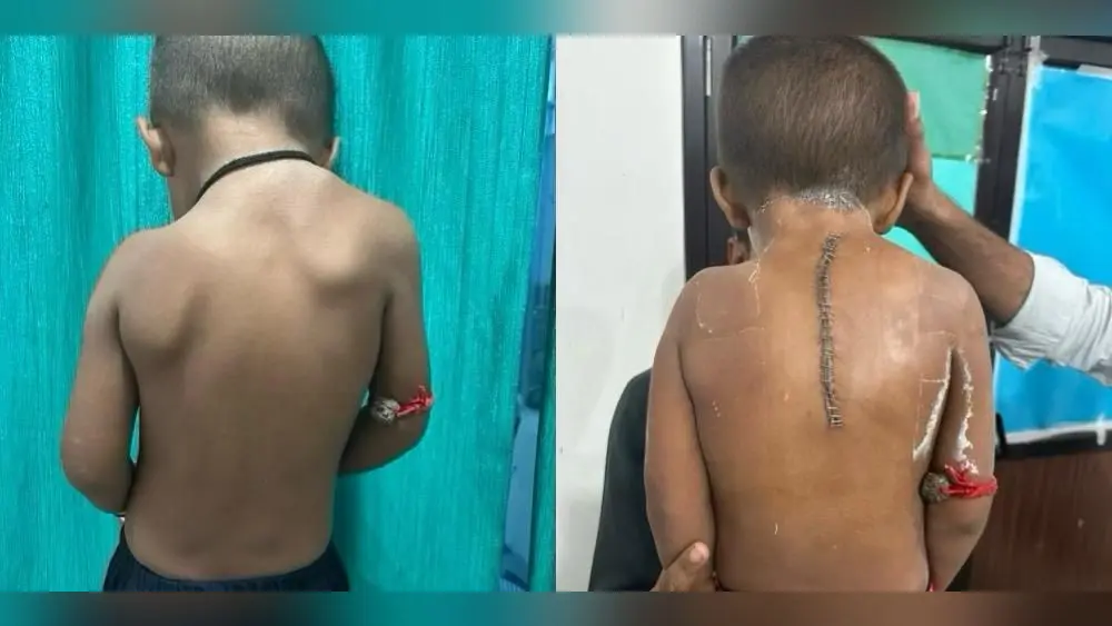 पश्चिम चंपारण में पहली बार दुर्लभ बीमारी की सफल सर्जरी, 4 साल के मासूम को मिली नई जिंदगी