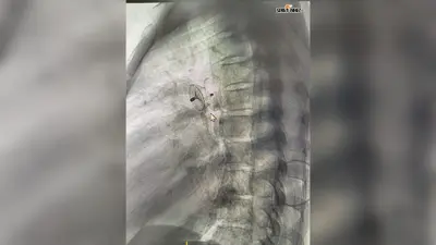दिल की धड़कनों को मिली नयी राह: एम्स देवघर में बिना ऑपरेशन जन्मजात हृदय दोष का पहला सफल इलाज