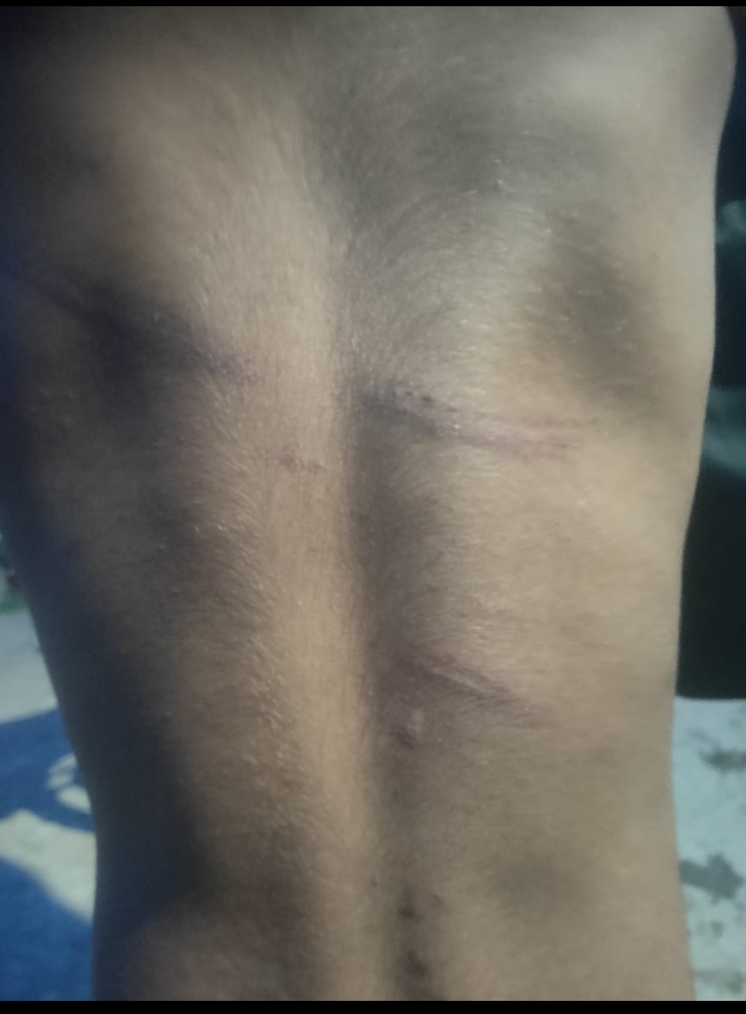 कैमूर में अंबेडकर आवासीय विद्यालय में 5 साल के मासूम की डंडे से पिटाई, आठवीं के छात्र पर बड़ी कार्रवाई