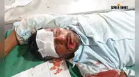 हजारीबाग में भीषण सड़क हादसा, पिता-पुत्री सहित तीन जख्मी
