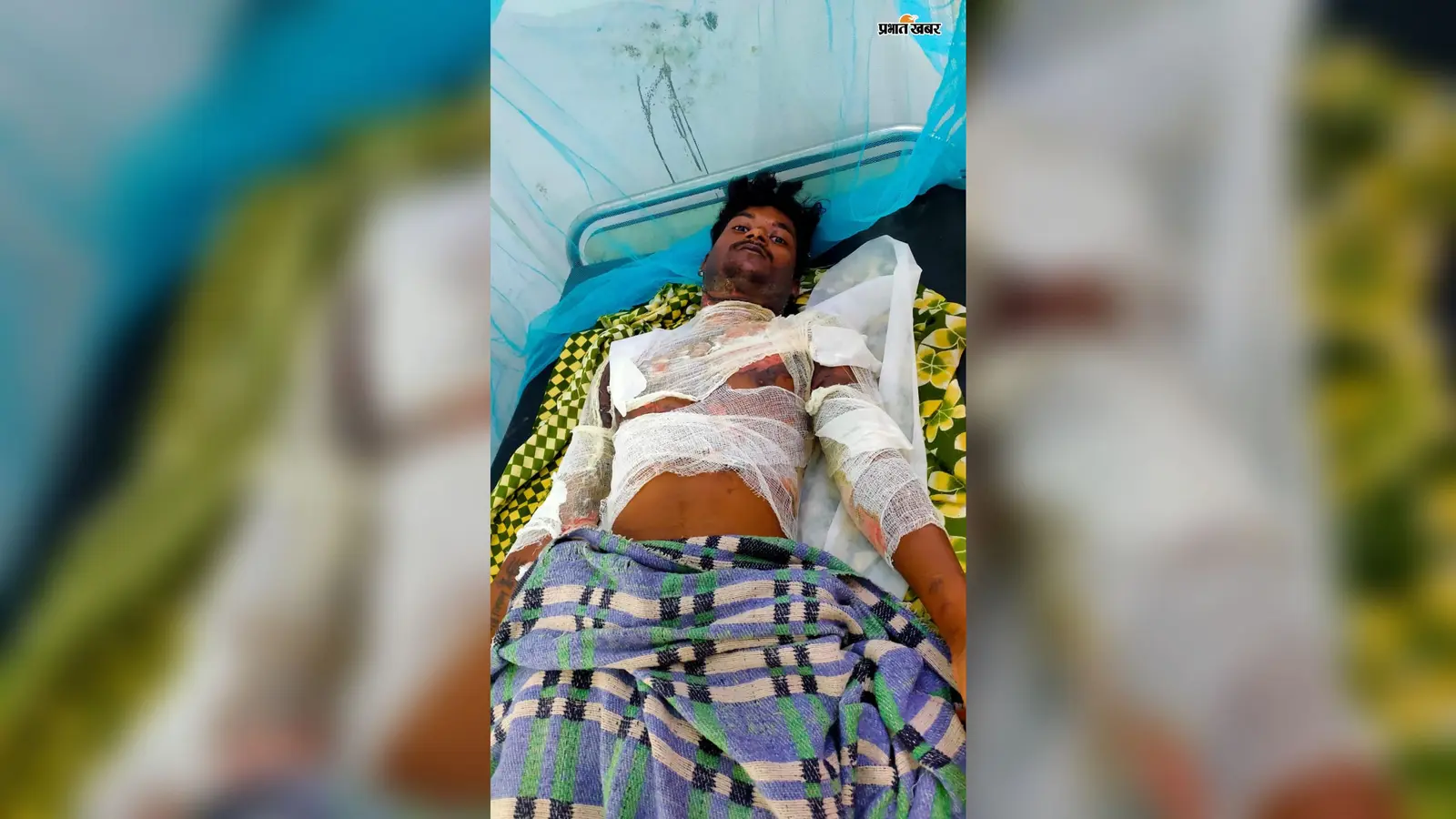 सिमडेगा में युवक पर पेट्रोल छिड़ककर लगाई आग, पुलिस ने शुरू की जांच