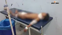 गोपालगंज में 6 साल के बच्चे पर अचानक आवारा कुत्तों ने किया हमला, गंभीर हालत में रेफर