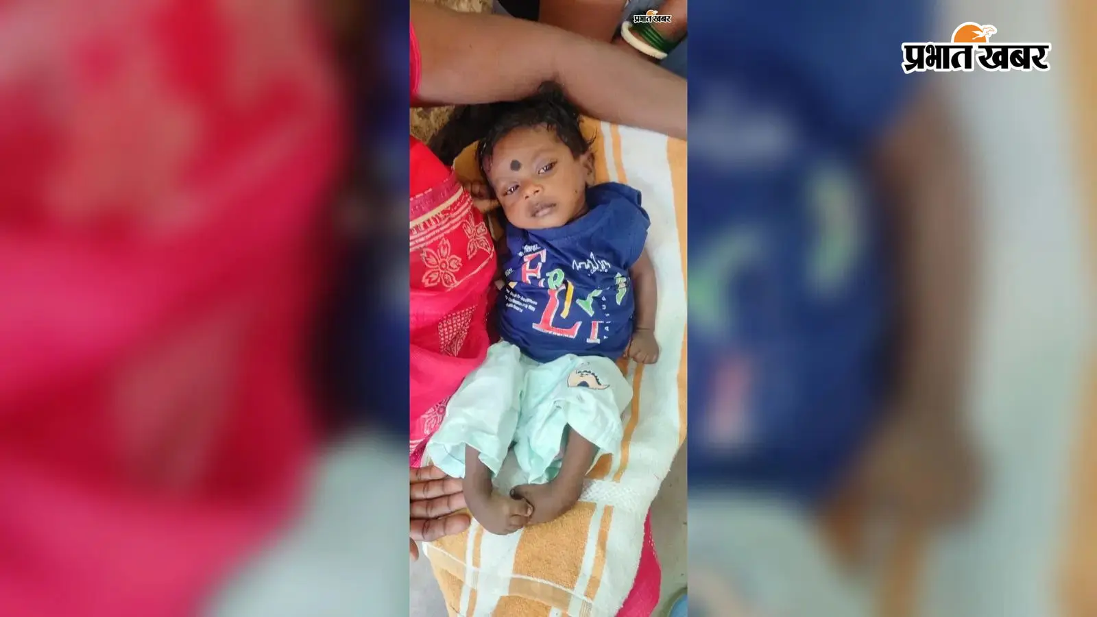 नवादा में क्लब फुट से पीड़ित बच्चों के लिए नई उम्मीद, सदर अस्पताल में शुरू हुआ नि:शुल्क उपचार