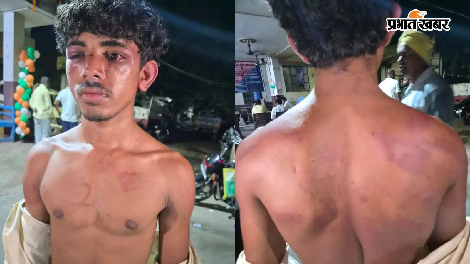 पटना में किशोर को काले शीशे वाली गाड़ी से उठा ले गये बदमाश, 4 घंटे तक पीटा, जलती सिगरेट से बनाया 3 का निशान