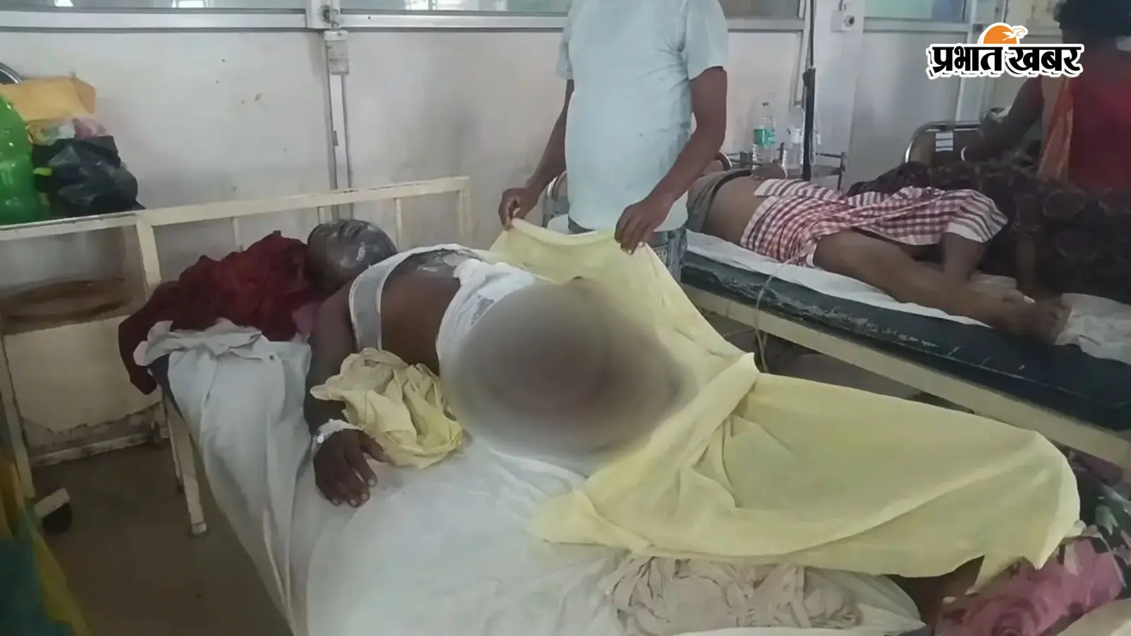 हाजीपुर: मेले में युवक को घेरकर पीटा, तेजाब फेंकने का आरोप; पुलिस बोली- गर्म तेल से झुलसने की बात