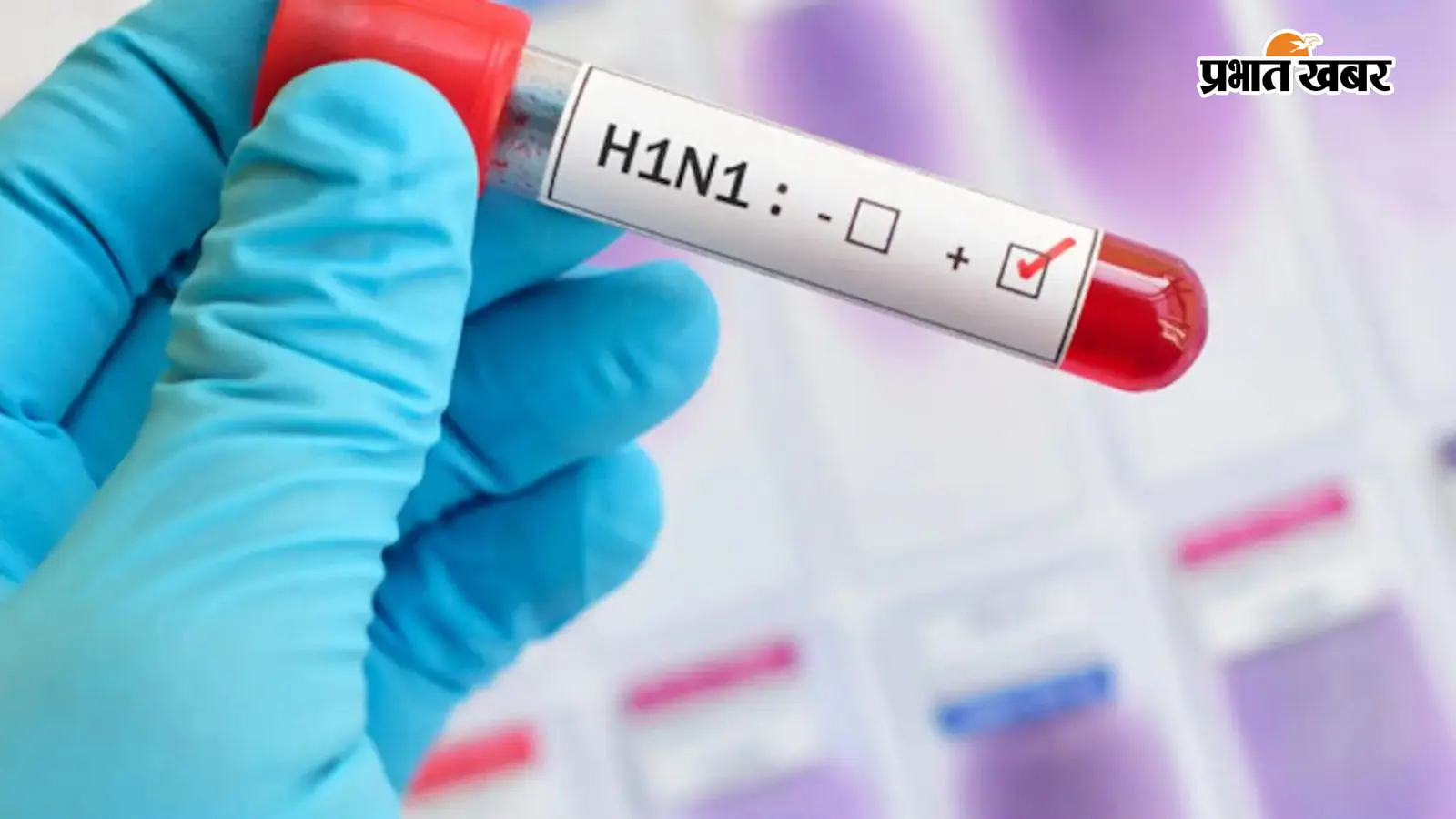 Swine Flu Alert: रांची में एक दिन में 3 नये केस, दो मासूम वेंटिलेटर पर; स्वास्थ्य विभाग अलर्ट
